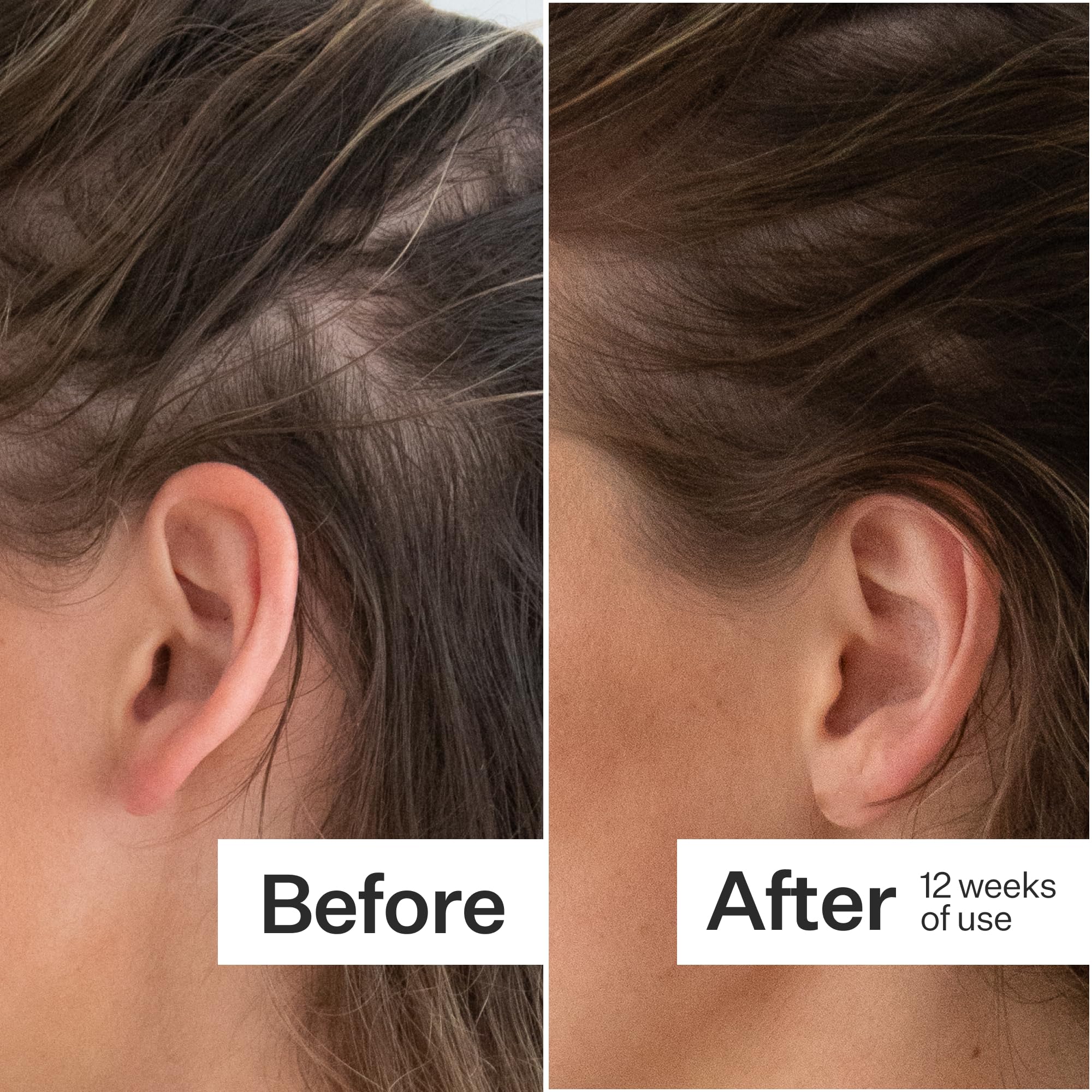 ACT+ ACRE Thick and Full Hair Capsules packaging