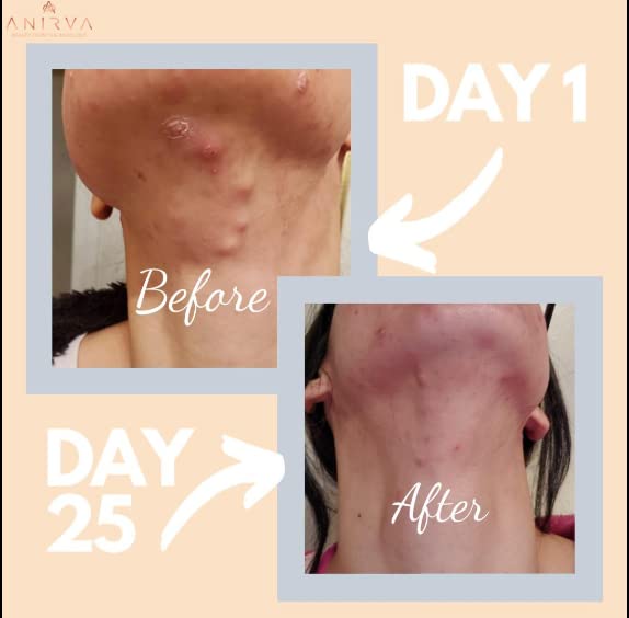ANIRVA ClearDerm Acne Supplements veggie capsules close-up