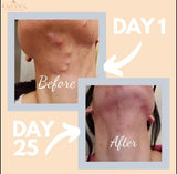 ANIRVA ClearDerm Acne Supplements veggie capsules close-up