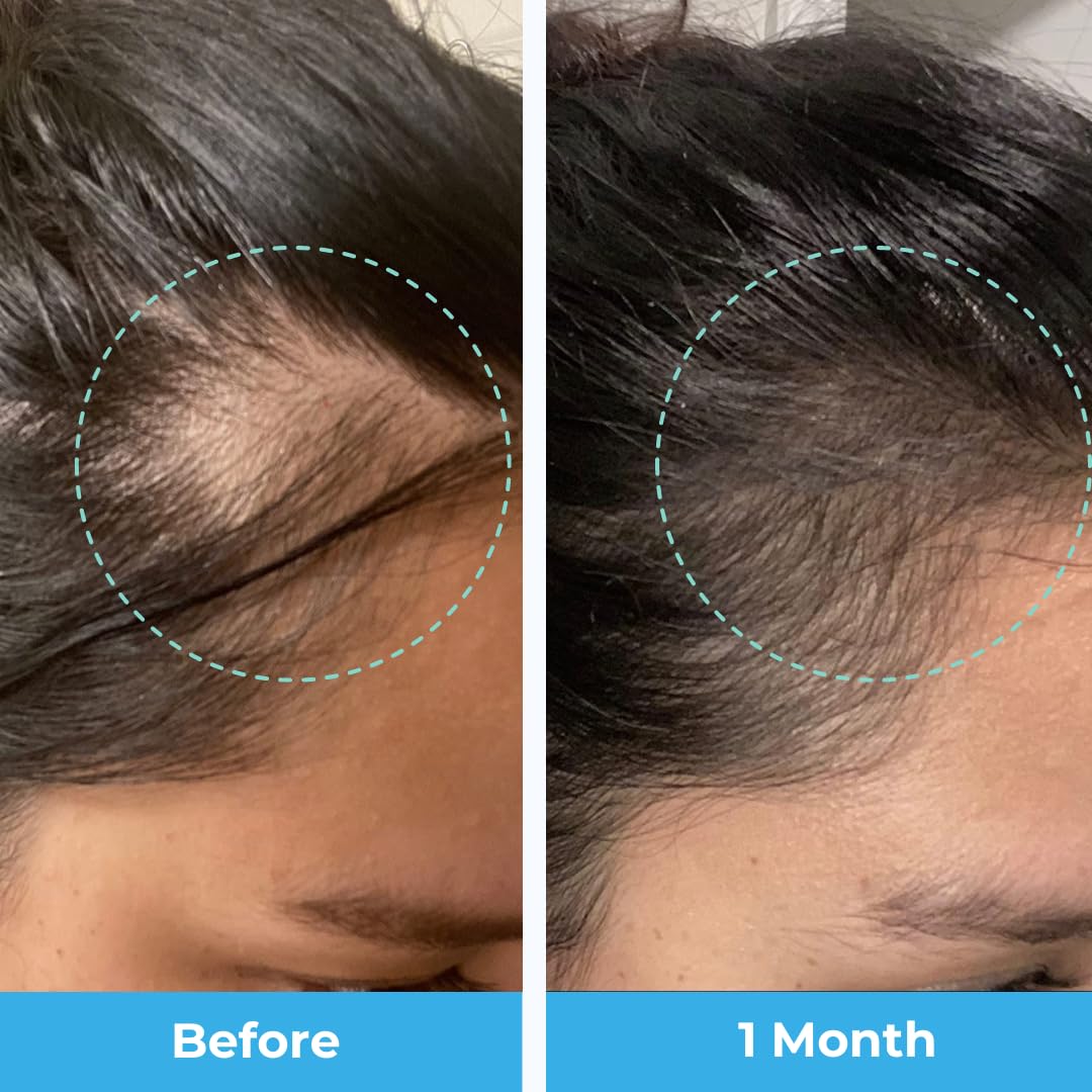 Baby Blues Postpartum Hair Loss Vitamins with tropical fruit background