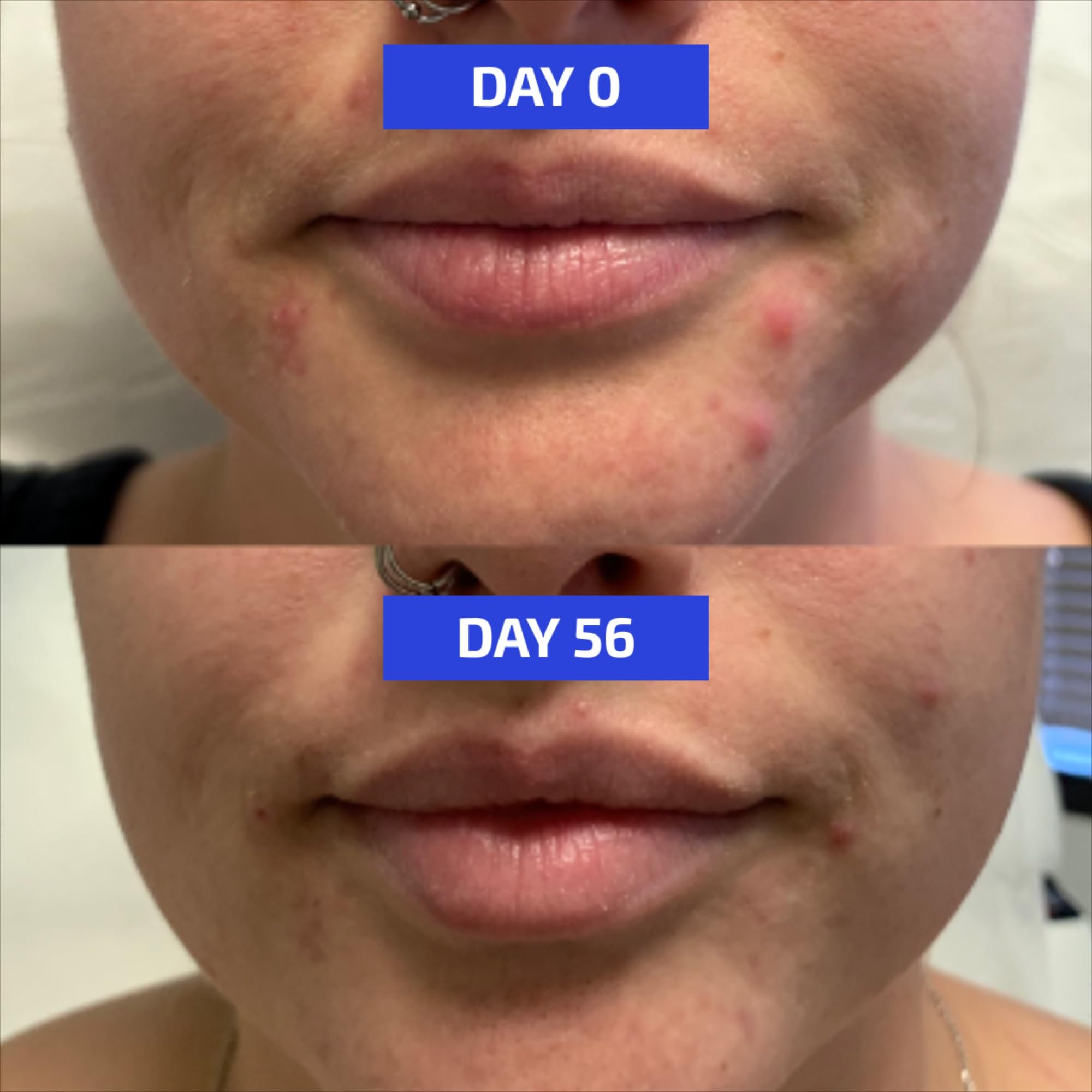 Codex Labs Shaant Clear Skin 2.0 capsule size comparison