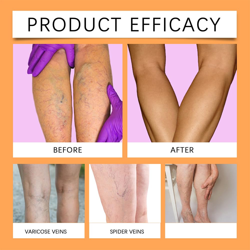 etitek Varicose Vein Patch applied on leg