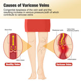 fangtaiabc Varicose Veins Patch lifestyle scene with user applying patch