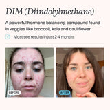 MDacne DIM Skin Clearing Supplements ingredients list