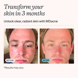 MDacne Skin Clearing Vitamins & Minerals capsules close-up